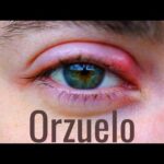Como curar un orzuelo en el ojo: Remedios caseros efectivos